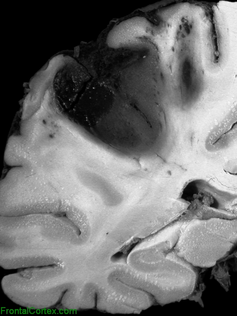 Superficial cerebral cortical hemorrhages, coronal section through parietal lobe.
